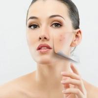 Acne treatment