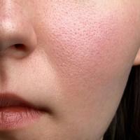 Pore treatment
