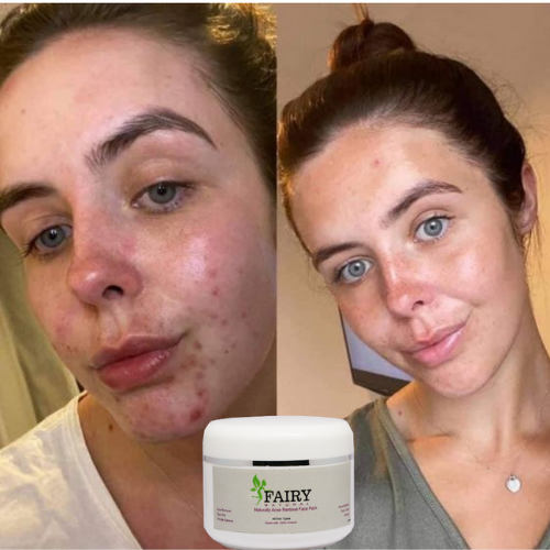 Fairy Naturally Acne Remove Face Pack